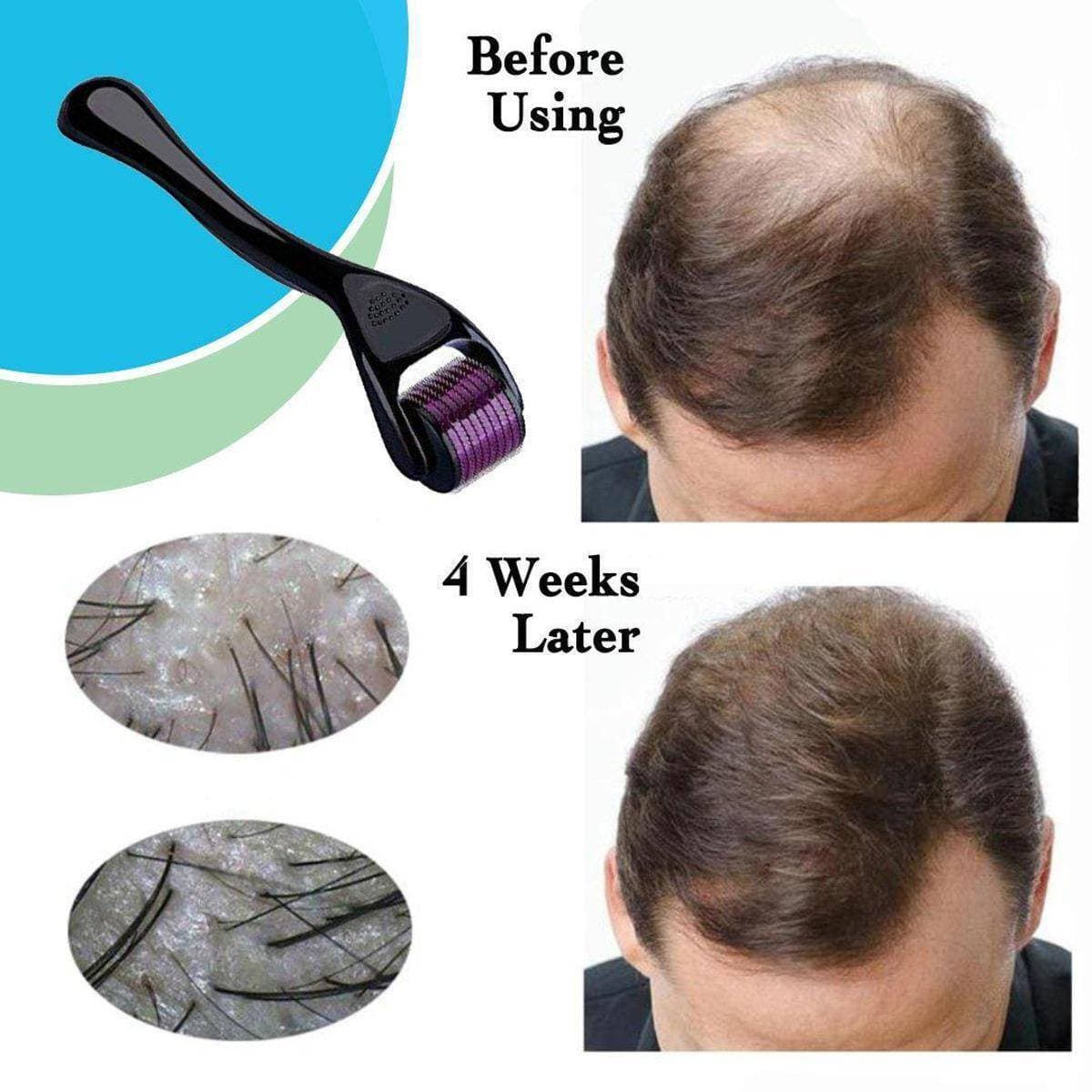 Healthy Derma Skin Roller Dermaroller Micro Needle Skin Care Therapy 0.5Mm